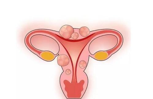 昆明女性长了子宫肌瘤有什么感觉？子宫肌瘤应该如何预防？